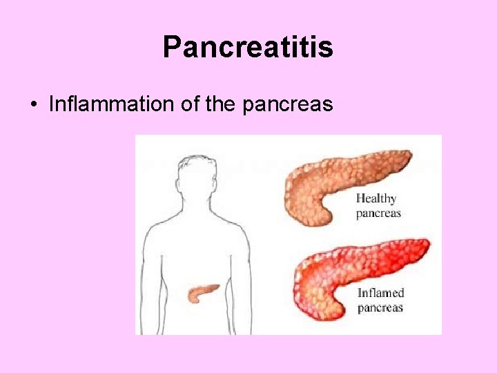 Pancreatitis • Inflammation of the pancreas 