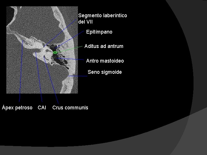 Segmento laberíntico del VII Epitímpano Aditus ad antrum Antro mastoideo Seno sigmoide Ápex petroso