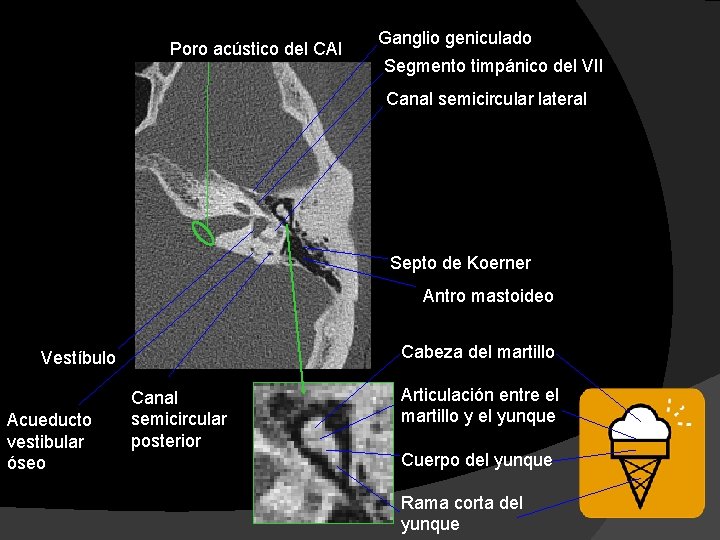 Poro acústico del CAI Ganglio geniculado Segmento timpánico del VII Canal semicircular lateral Septo