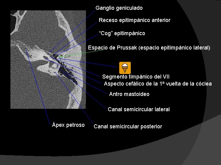 Ganglio geniculado Receso epitimpánico anterior “Cog” epitimpánico Espacio de Prussak (espacio epitimpánico lateral) Segmento