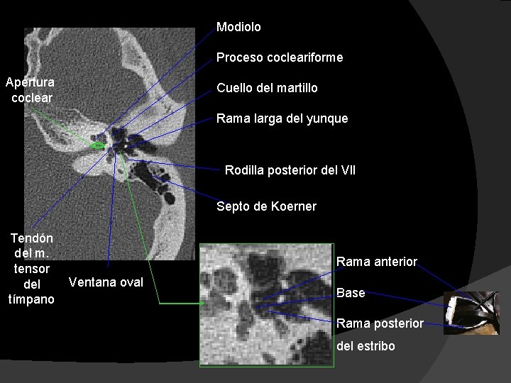 Modiolo Proceso cocleariforme Apertura coclear Cuello del martillo Rama larga del yunque Rodilla posterior