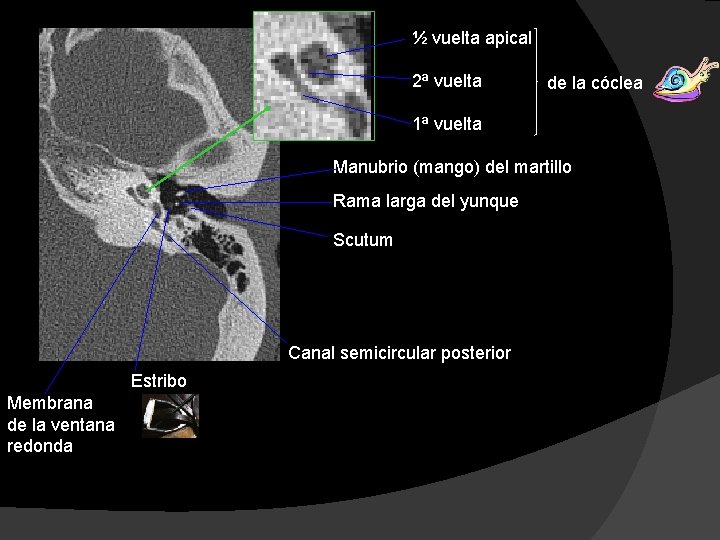 ½ vuelta apical 2ª vuelta de la cóclea 1ª vuelta Manubrio (mango) del martillo