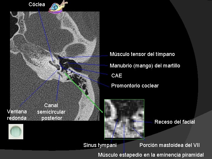 Cóclea Músculo tensor del tímpano Manubrio (mango) del martillo CAE Promontorio coclear Ventana redonda