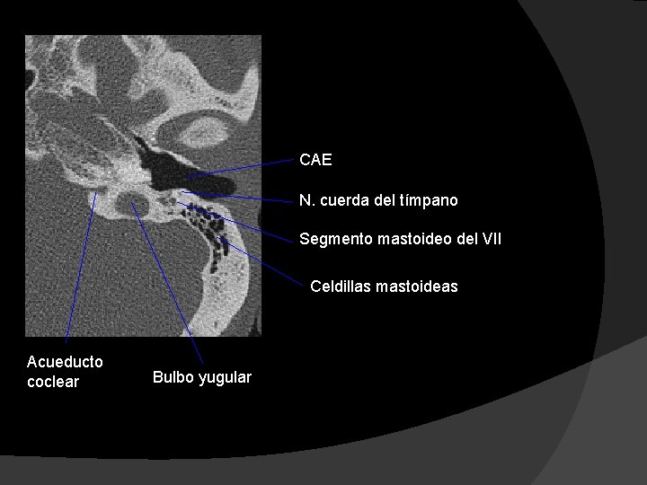 CAE N. cuerda del tímpano Segmento mastoideo del VII Celdillas mastoideas Acueducto coclear Bulbo