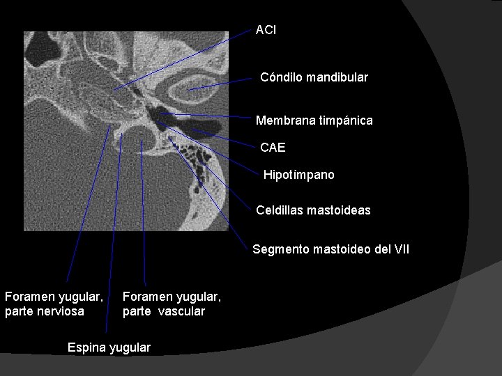 ACI Cóndilo mandibular Membrana timpánica CAE Hipotímpano Celdillas mastoideas Segmento mastoideo del VII Foramen