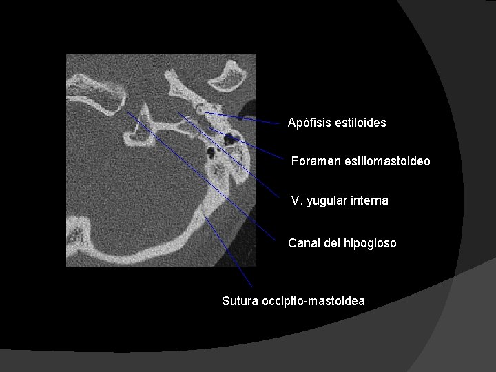 Apófisis estiloides Foramen estilomastoideo V. yugular interna Canal del hipogloso Sutura occipito-mastoidea 