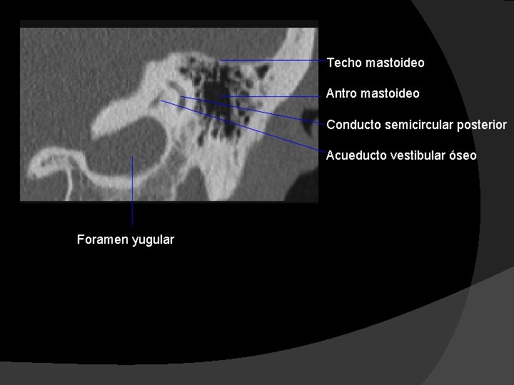 Techo mastoideo Antro mastoideo Conducto semicircular posterior Acueducto vestibular óseo Foramen yugular 