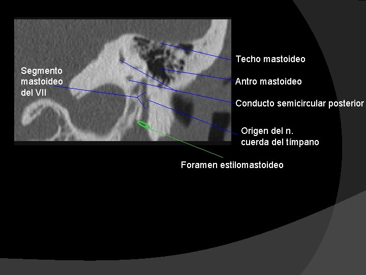 Techo mastoideo Segmento mastoideo del VII Antro mastoideo Conducto semicircular posterior Origen del n.