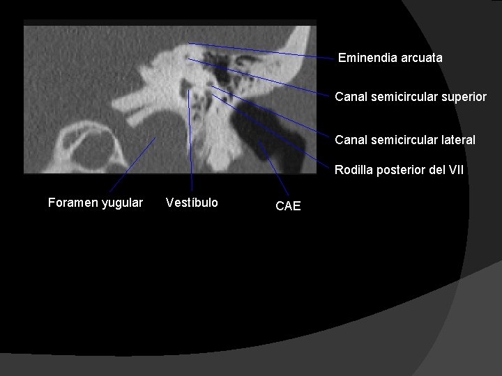 Eminendia arcuata Canal semicircular superior Canal semicircular lateral Rodilla posterior del VII Foramen yugular