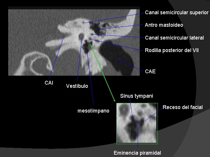 Canal semicircular superior Antro mastoideo Canal semicircular lateral Rodilla posterior del VII CAE CAI