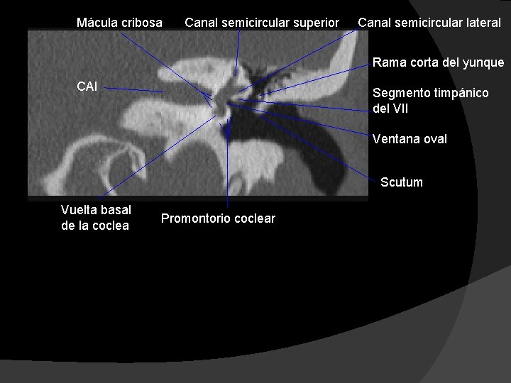 Mácula cribosa Canal semicircular superior Canal semicircular lateral Rama corta del yunque CAI Segmento
