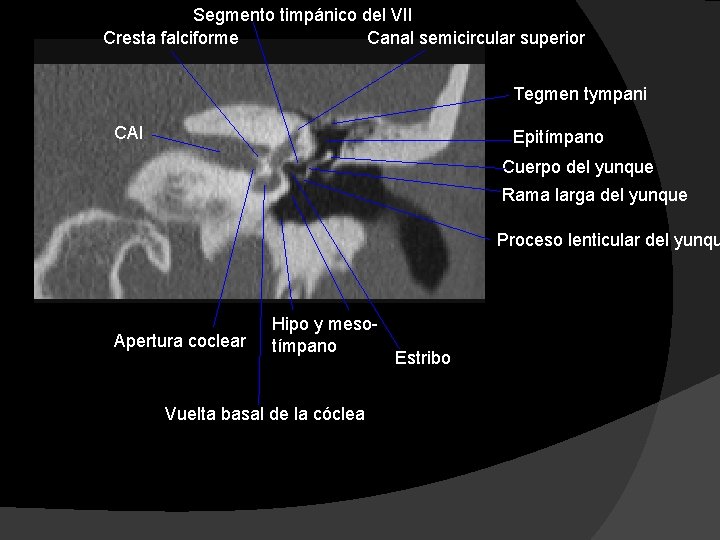 Segmento timpánico del VII Cresta falciforme Canal semicircular superior Tegmen tympani CAI Epitímpano Cuerpo