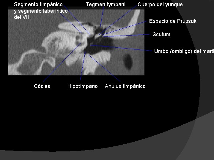 Segmento timpánico y segmento laberíntico del VII Tegmen tympani Cuerpo del yunque Espacio de
