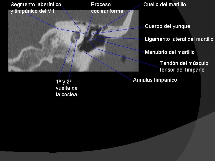 Segmento laberíntico y timpánico del VII Proceso cocleariforme Cuello del martillo Cuerpo del yunque
