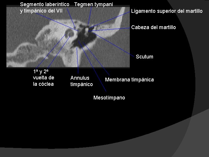 Segmento laberíntico Tegmen tympani y timpánico del VII Ligamento superior del martillo Cabeza del