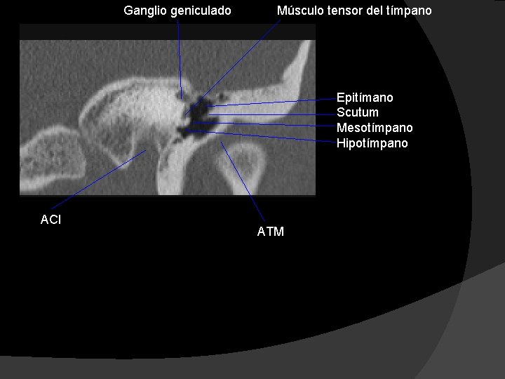 Ganglio geniculado Músculo tensor del tímpano Epitímano Scutum Mesotímpano Hipotímpano ACI ATM 
