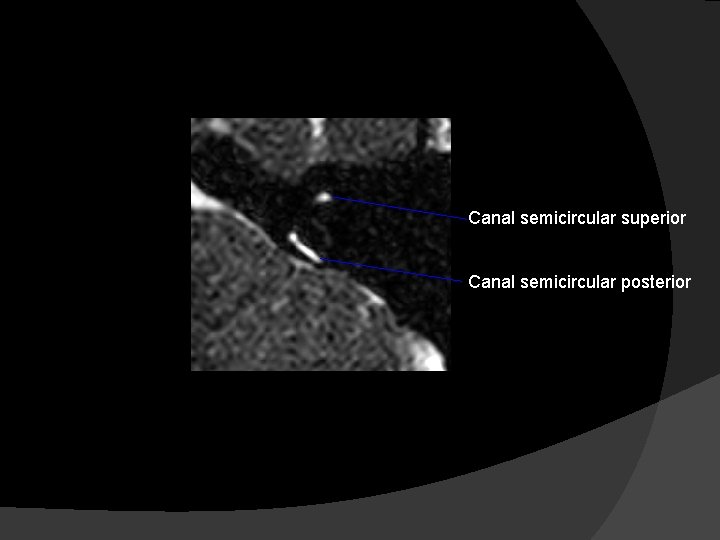 Canal semicircular superior Canal semicircular posterior 