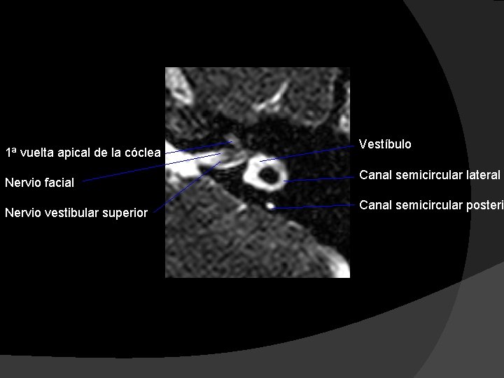 1ª vuelta apical de la cóclea Nervio facial Nervio vestibular superior Vestíbulo Canal semicircular