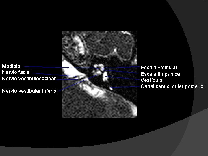 Modiolo Nervio facial Nervio vestibulococlear Nervio vestibular inferior Escala vetibular Escala timpánica Vestíbulo Canal