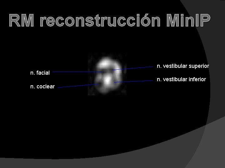 RM reconstrucción Min. IP n. vestibular superior n. facial n. vestibular inferior n. coclear