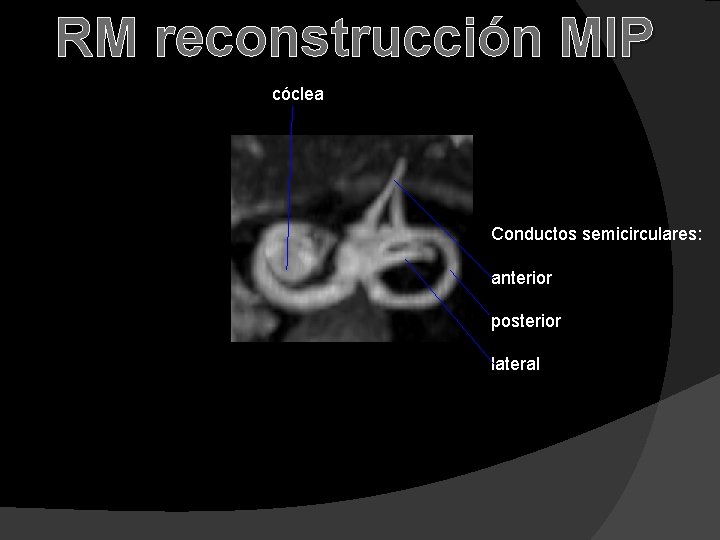 RM reconstrucción MIP cóclea Conductos semicirculares: anterior posterior lateral 