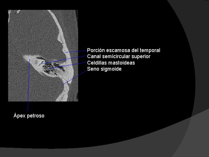 Porción escamosa del temporal Canal semicircular superior Celdillas mastoideas Seno sigmoide Ápex petroso 