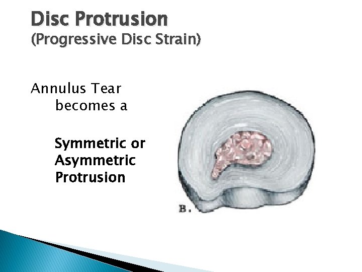 Disc Protrusion (Progressive Disc Strain) Annulus Tear becomes a Symmetric or Asymmetric Protrusion 