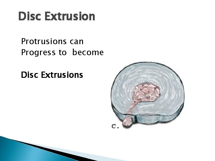 Disc Extrusion Protrusions can Progress to become Disc Extrusions Disc Extrusion Protrusions can Progress to become Disc Extrusions