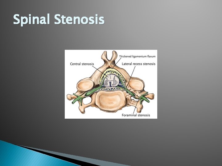 Spinal Stenosis Spinal Stenosis