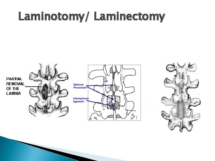 Laminotomy/ Laminectomy 