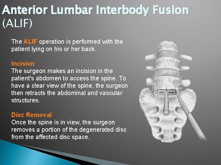 Anterior Lumbar Interbody Fusion (ALIF) The ALIF operation is performed with the patient lying Anterior Lumbar Interbody Fusion (ALIF) The ALIF operation is performed with the patient lying