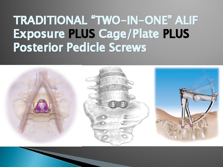 TRADITIONAL “TWO-IN-ONE” ALIF Exposure PLUS Cage/Plate PLUS Posterior Pedicle Screws 