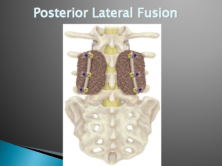 Posterior Lateral Fusion Posterior Lateral Fusion