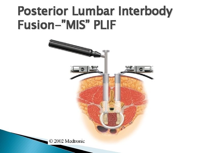 Posterior Lumbar Interbody Fusion-”MIS” PLIF Posterior Lumbar Interbody Fusion-”MIS” PLIF