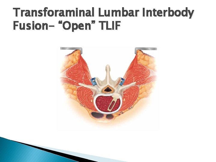 Transforaminal Lumbar Interbody Fusion- “Open” TLIF 