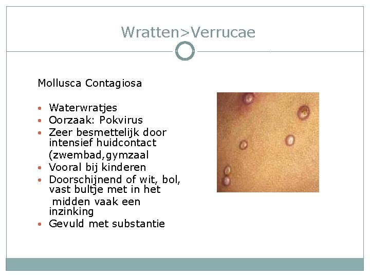 Wratten>Verrucae Mollusca Contagiosa • Waterwratjes • Oorzaak: Pokvirus • Zeer besmettelijk door intensief huidcontact