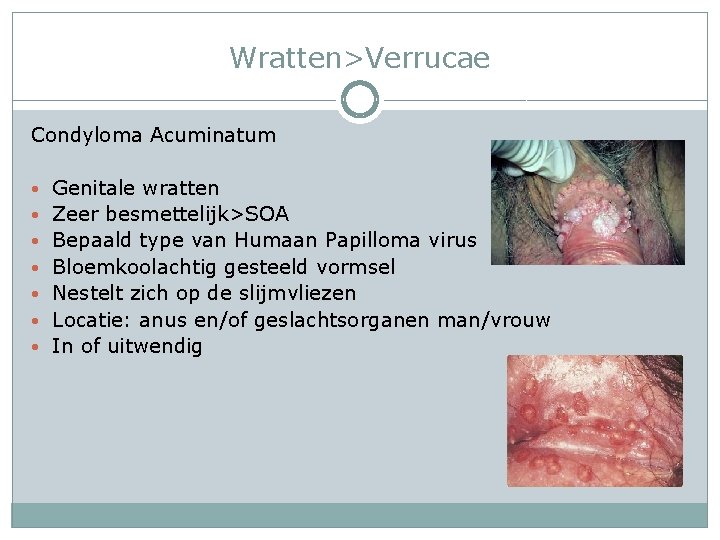 Wratten>Verrucae Condyloma Acuminatum • Genitale wratten • Zeer besmettelijk>SOA • Bepaald type van Humaan