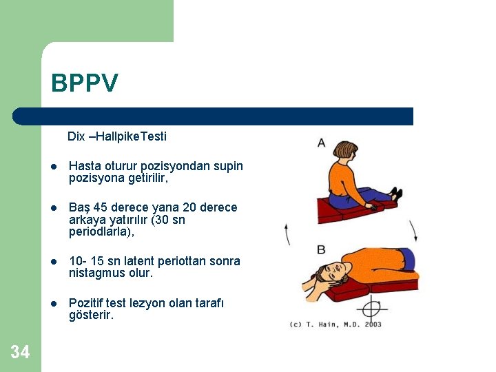 BPPV Dix –Hallpike. Testi 34 l Hasta oturur pozisyondan supin pozisyona getirilir, l Baş