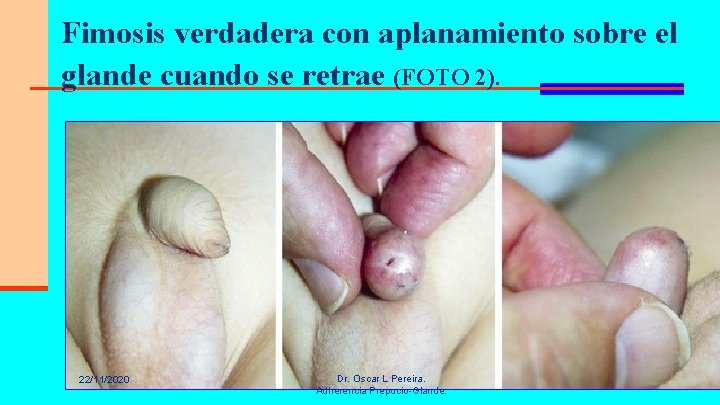Fimosis verdadera con aplanamiento sobre el glande cuando se retrae (FOTO 2). 22/11/2020 Dr.