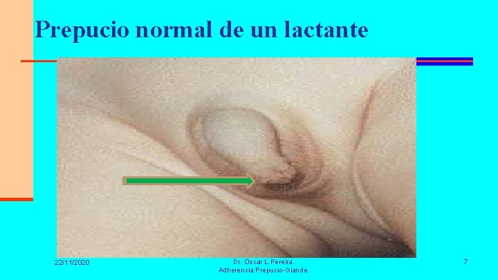 Prepucio normal de un lactante 22/11/2020 Dr. Oscar L Pereira. Adherencia Prepucio-Glande. 7 