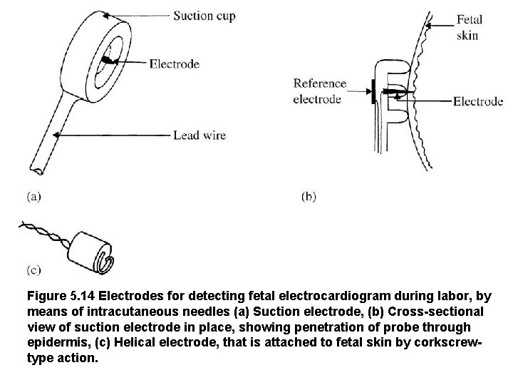 Figure 5. 14 Electrodes for detecting fetal electrocardiogram during labor, by means of intracutaneous