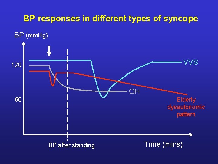 BP responses in different types of syncope BP (mm. Hg) VVS 120 OH 60