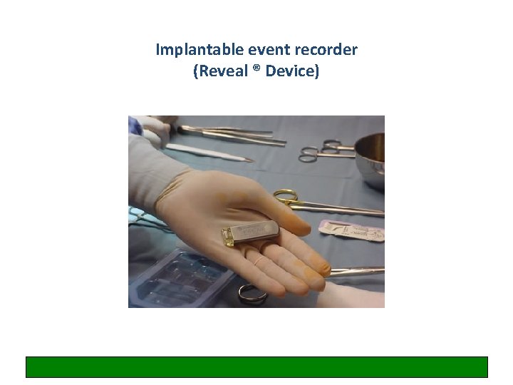 Implantable event recorder (Reveal ® Device) 