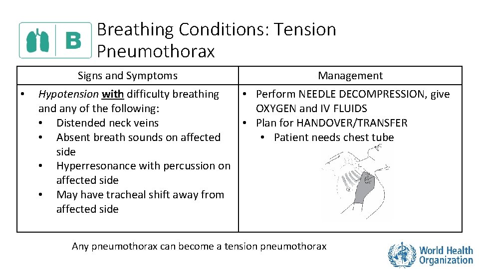 Breathing Conditions: Tension Pneumothorax Signs and Symptoms • Management Hypotension with difficulty breathing •