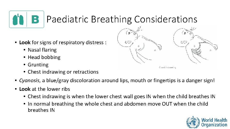 Paediatric Breathing Considerations • Look for signs of respiratory distress : • Nasal flaring