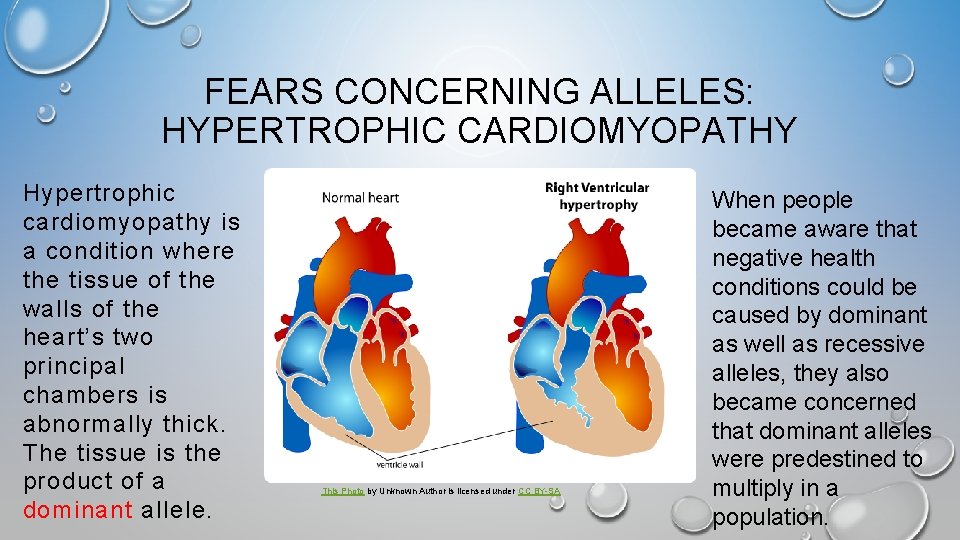 FEARS CONCERNING ALLELES: HYPERTROPHIC CARDIOMYOPATHY Hypertrophic cardiomyopathy is a condition where the tissue of