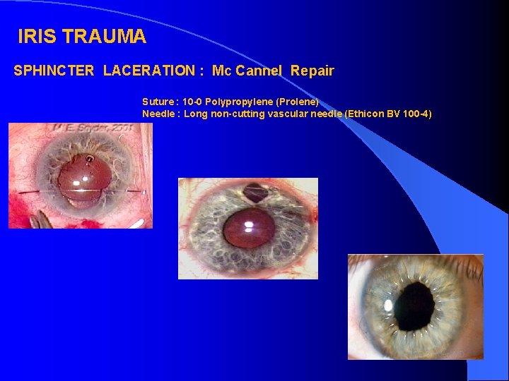 IRIS TRAUMA SPHINCTER LACERATION : Mc Cannel Repair Suture : 10 -0 Polypropylene (Prolene)