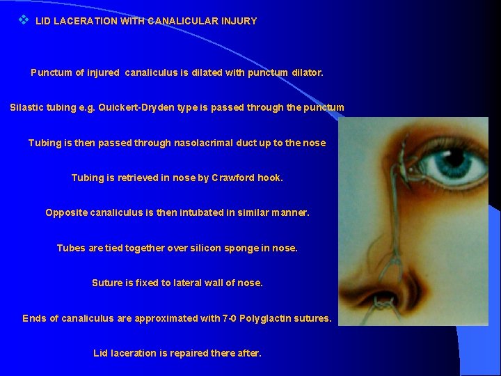 v LID LACERATION WITH CANALICULAR INJURY Punctum of injured canaliculus is dilated with punctum