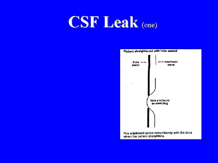 CSF Leak (one) 