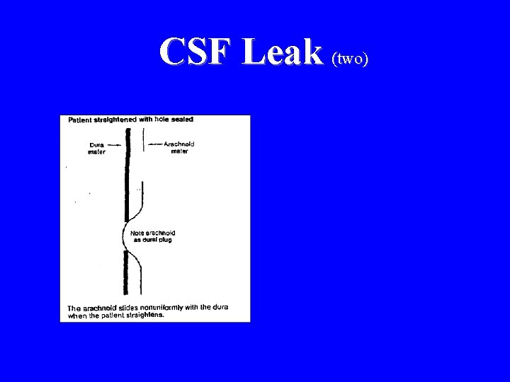 CSF Leak (two) 